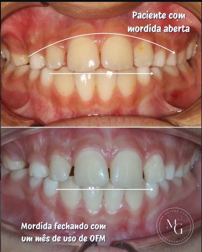 Caso 01: vista frontal antes e depois do tratamento