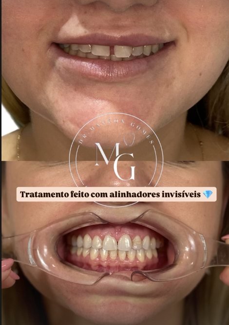 Caso 03: comparação de antes e depois do tratamento