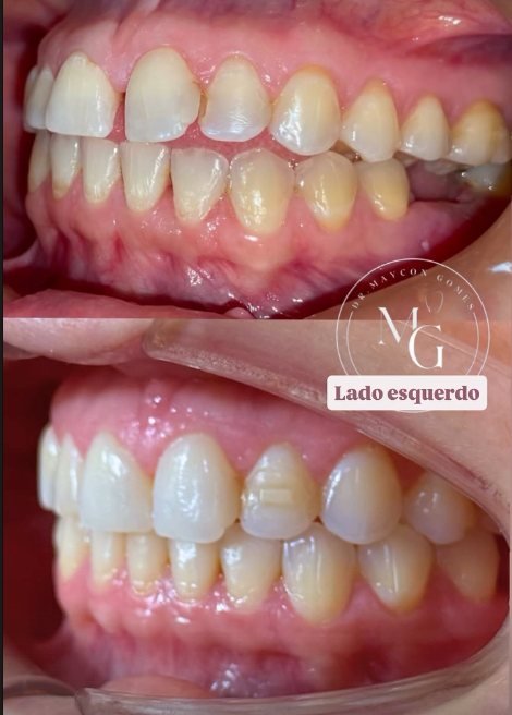Caso 04: vista lateral esquerda antes e depois do tratamento